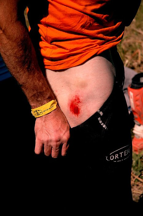 17.01.2009 Poškodba noge